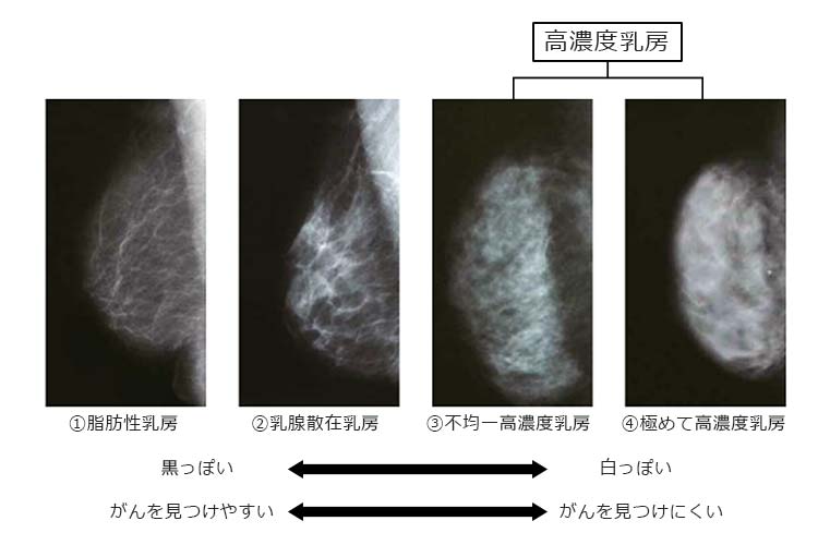 高濃度乳房を比較するマンモグラフィの写真